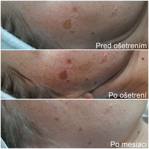 Pigmentácia pred, po a mesiac po ošetrení 